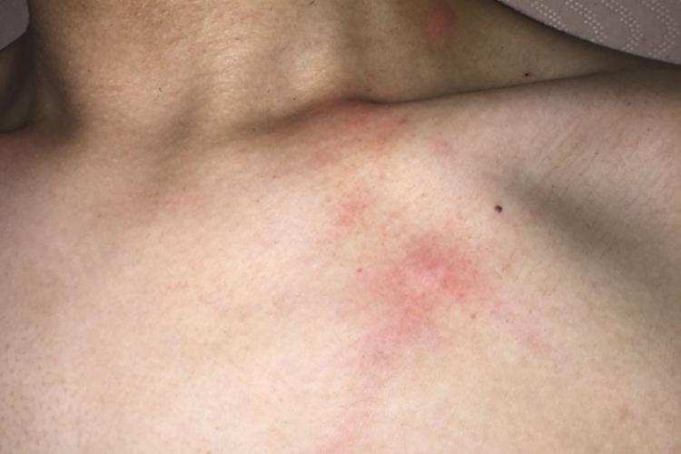 锁骨处湿疹红斑图