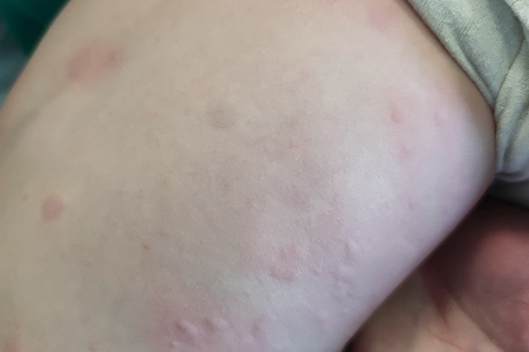 孩子荨麻疹图