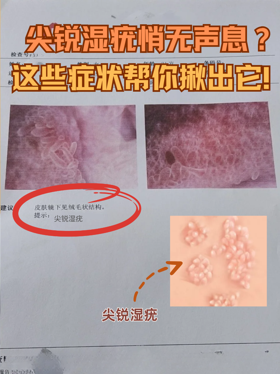 尖锐湿疣悄无声息？这些症状帮你揪出它！