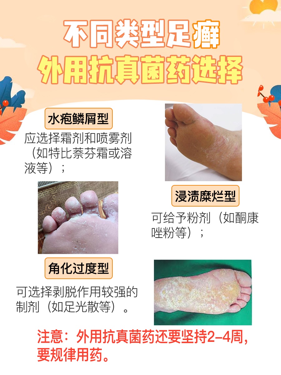 抗击脚气,盐酸特比萘芬喷雾剂真的有效吗?