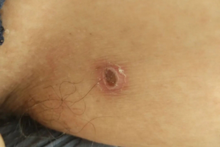 恙螨皮炎结痂图