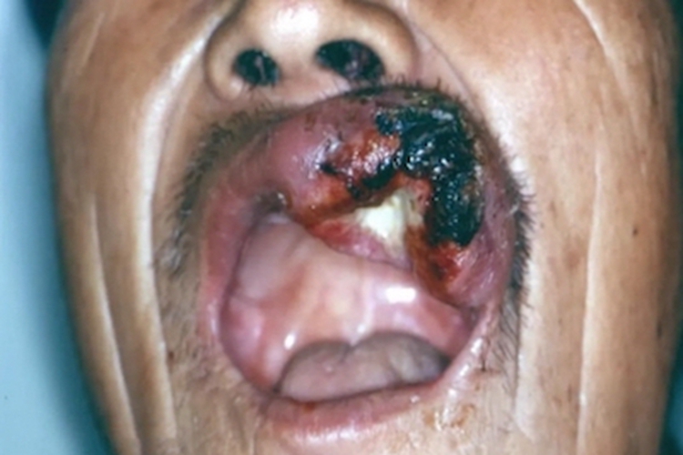 头部鳞状细胞癌嘴唇症状图