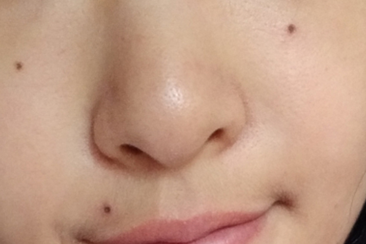 药水点痣掉痂后皮肤表现图