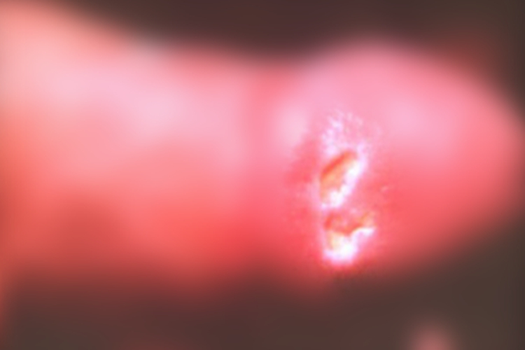 阴茎结核疹龟头溃疡图