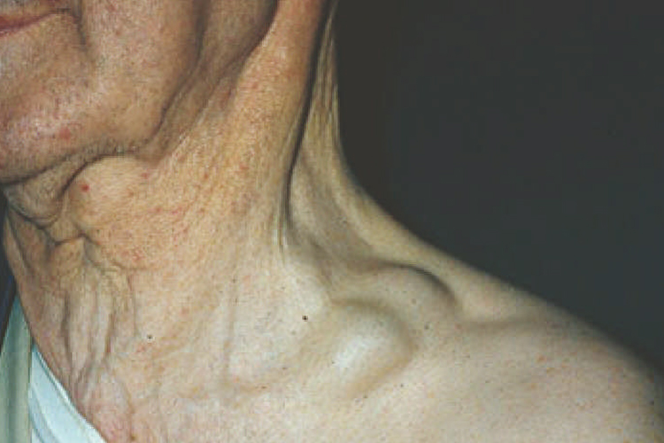 恶性淋巴瘤晚期淋巴结肿大图 恶性淋巴瘤晚期淋巴结肿大图