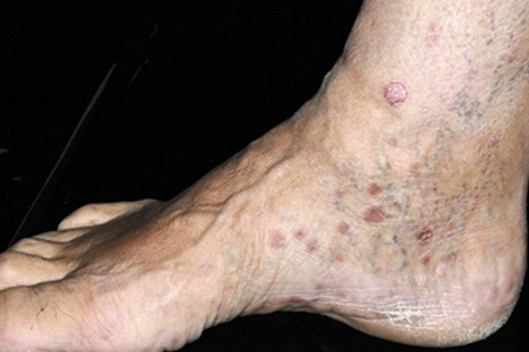 女性梅毒脚踝结节图