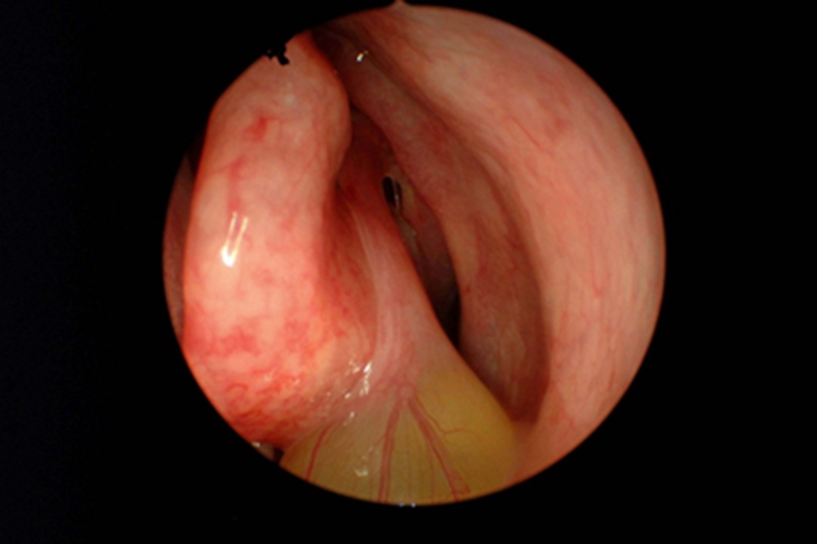 急性化脓性鼻窦炎症状图