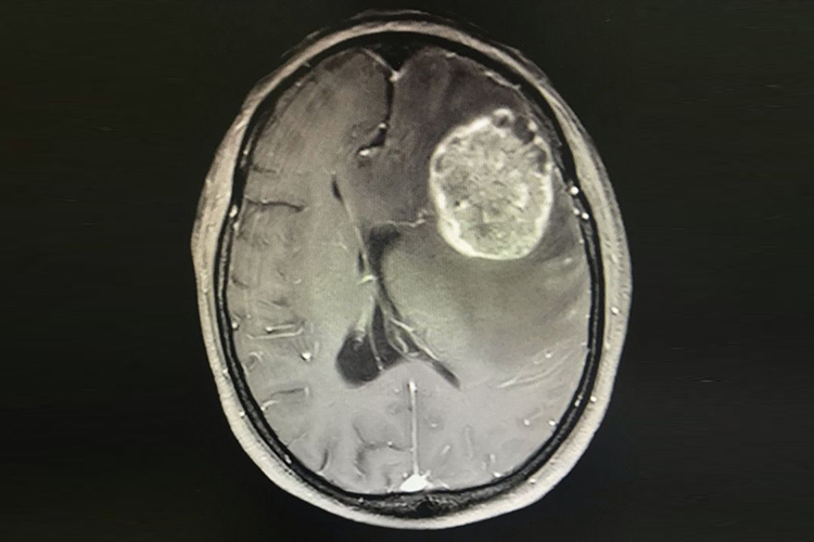 脑癌核磁图