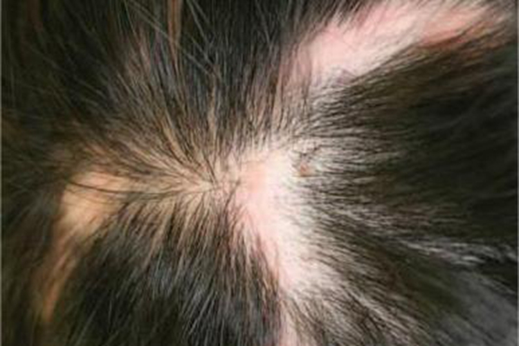 深在性红斑狼疮头皮红斑图 深在性红斑狼疮头皮红斑图