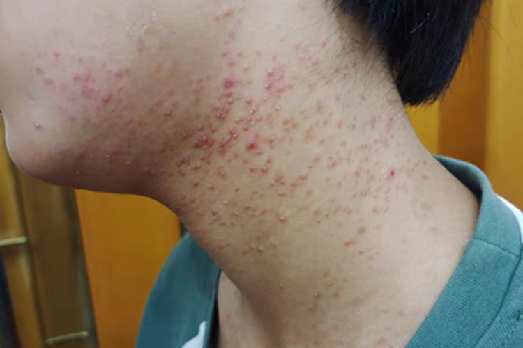 毛囊炎侧颈症状图