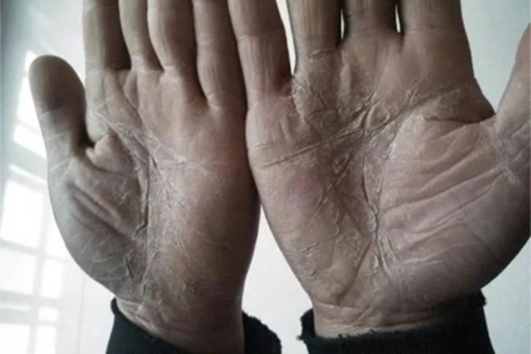 鳞屑角化型手癣手掌皮肤增厚图