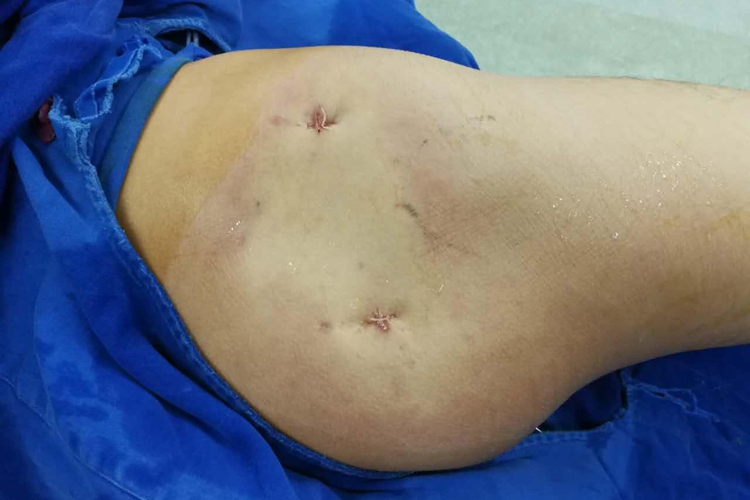 臀肌挛缩症臀部外侧凹陷图