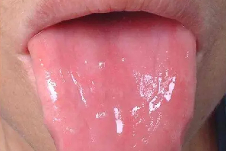 光滑舌图 光滑舌图