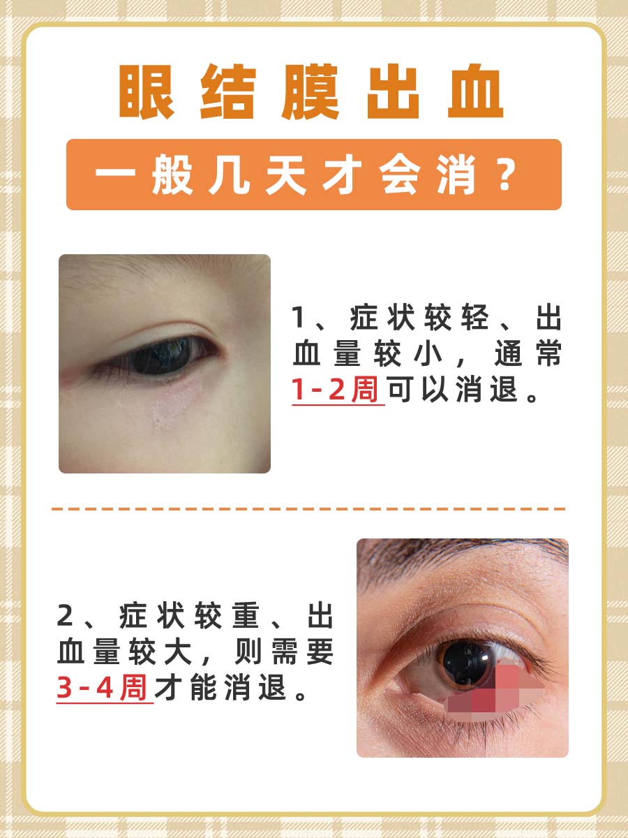 眼结膜出血几天消？速来了解恢复周期