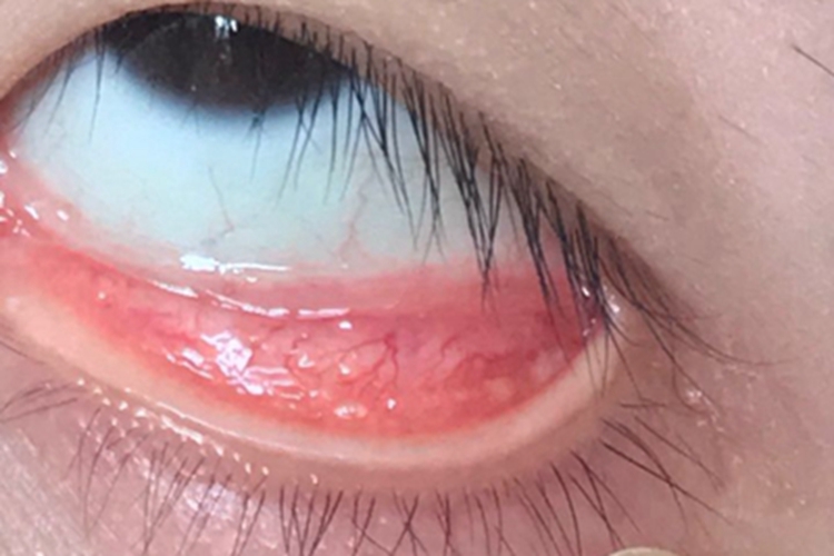 滤泡性结膜炎结膜水疱图 滤泡性结膜炎结膜水疱图