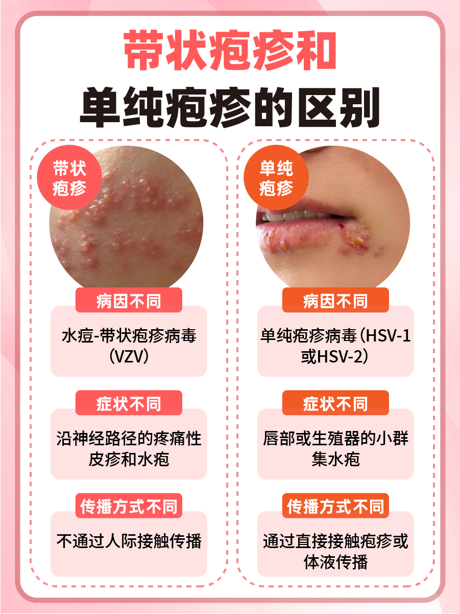 带状疱疹vs单纯疱疹：区别大揭秘！