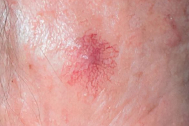 蜘蛛痣丘疹图 蜘蛛痣丘疹图