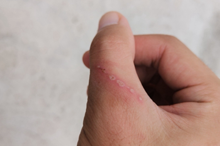 隐翅虫皮炎手指症状图