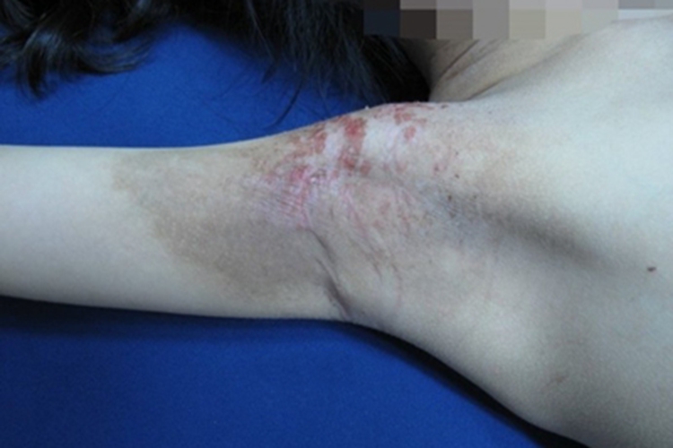 红癣腋窝症状图 红癣腋窝症状图