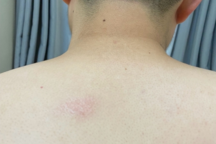 局限性神经性皮炎后背有斑片图