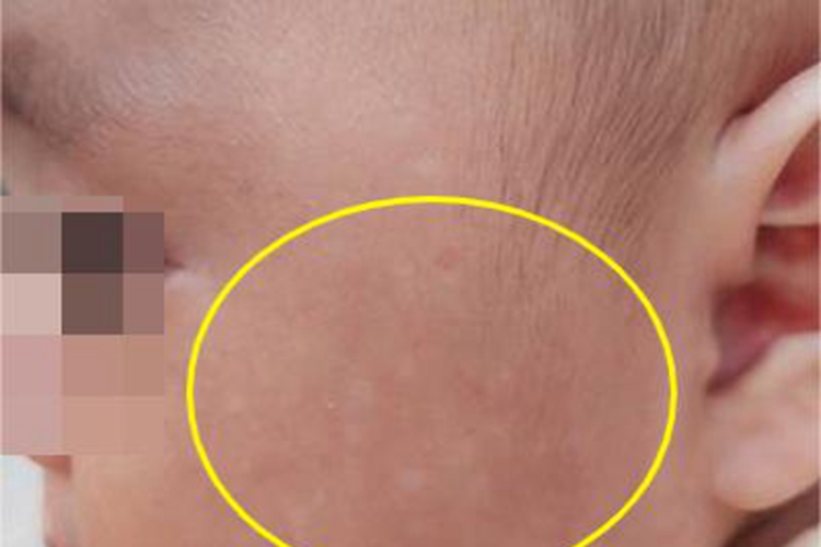 特发性点状色素减退斑面部症状图 特发性点状色素减退斑面部症状图