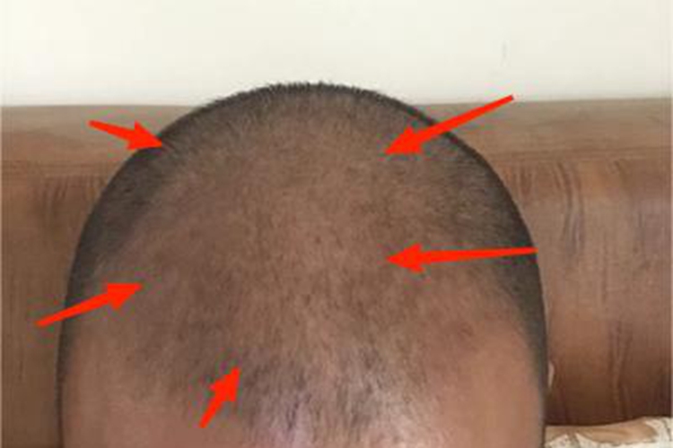 雄激素性脱发头部掉发图 雄激素性脱发头部掉发图