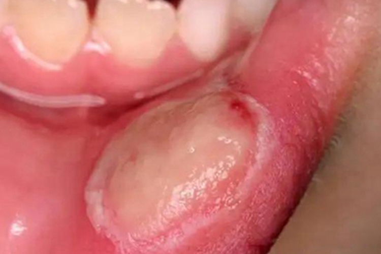 小儿口疮糜烂图 小儿口疮糜烂图