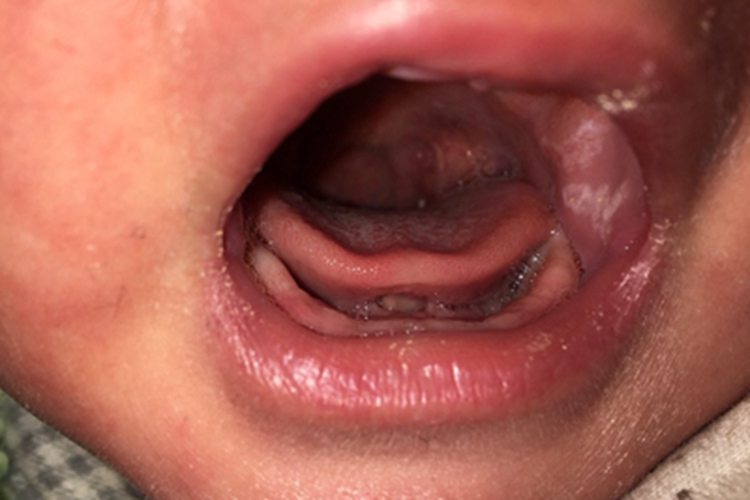 鹅口疮口腔左侧有白斑图 鹅口疮口腔左侧有白斑图