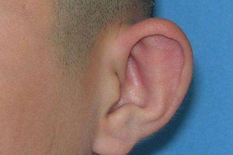 招风耳耳廓朝前倾图 招风耳耳廓朝前倾图