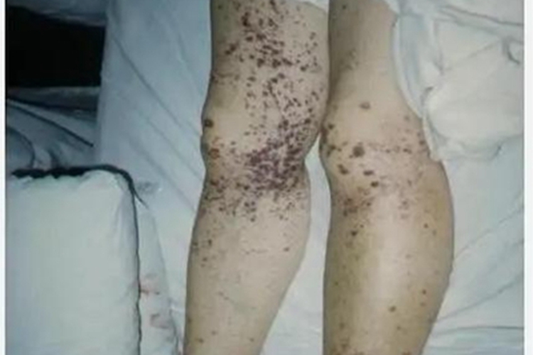 血栓性血小板减少性紫癜紫斑图 血栓性血小板减少性紫癜紫斑图