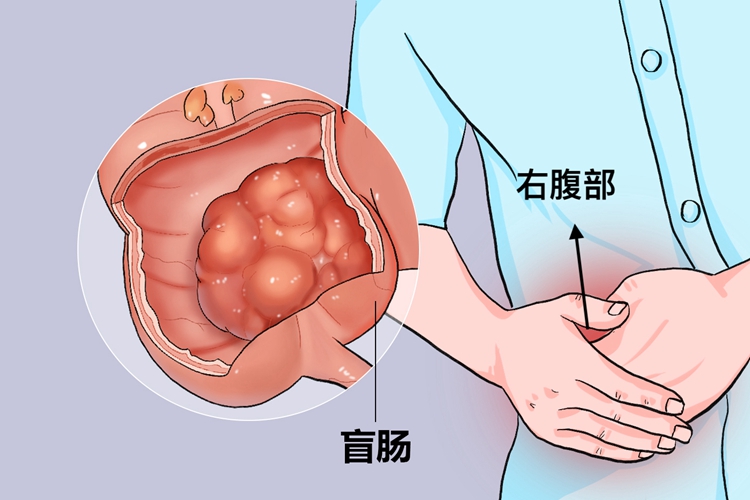 正常盲肠位于右腹部图