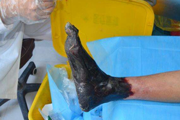 干性坏疽脚部皮肤发黑图片