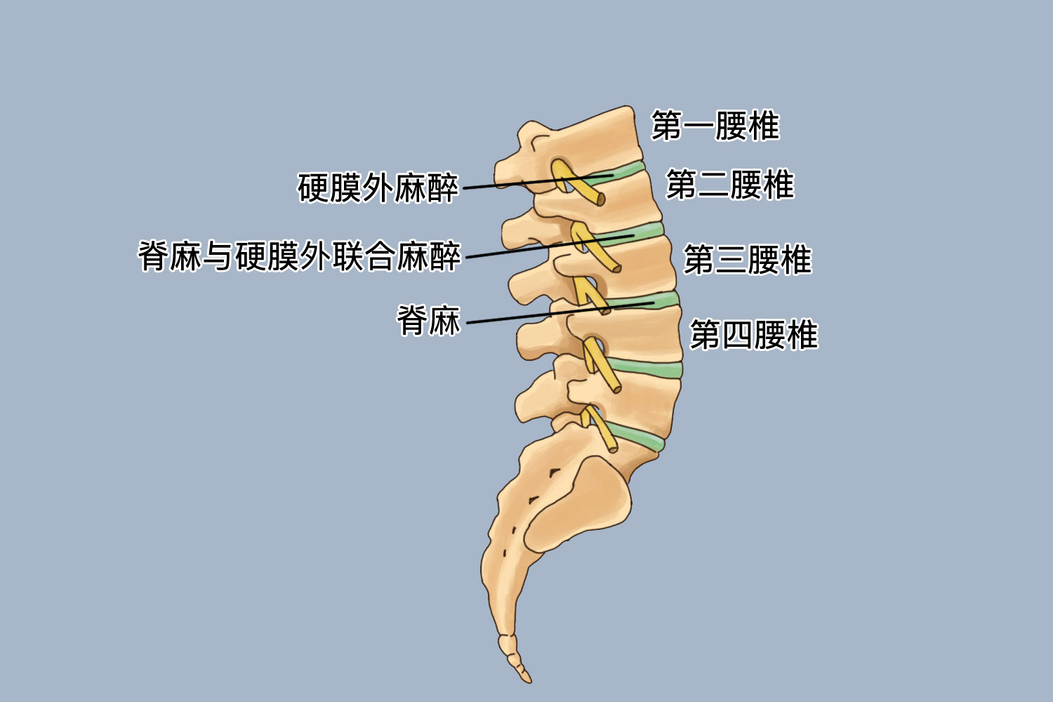 剖腹产麻醉位置图