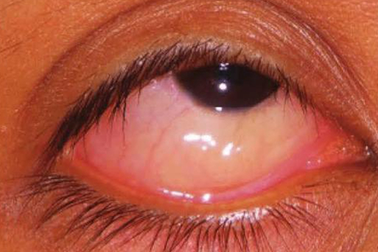 过敏性结膜炎图