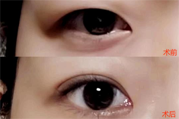 双眼皮效果图