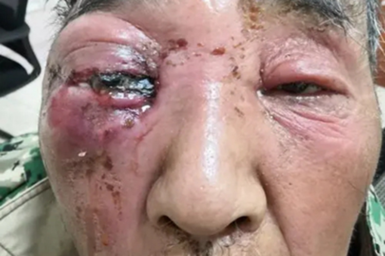 眼眶蜂窝织炎化脓图 眼眶蜂窝织炎化脓图