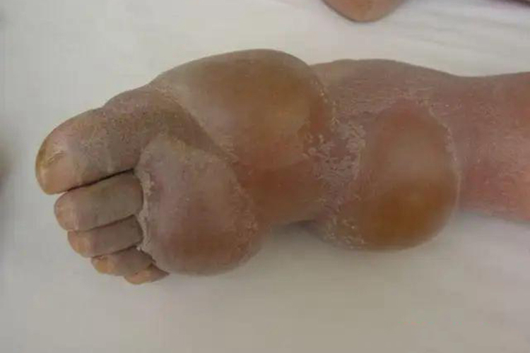 糖尿病大疱病图