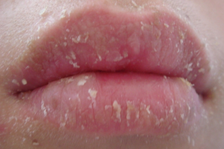 剥脱性唇炎嘴唇有大片脱皮图 剥脱性唇炎嘴唇有大片脱皮图