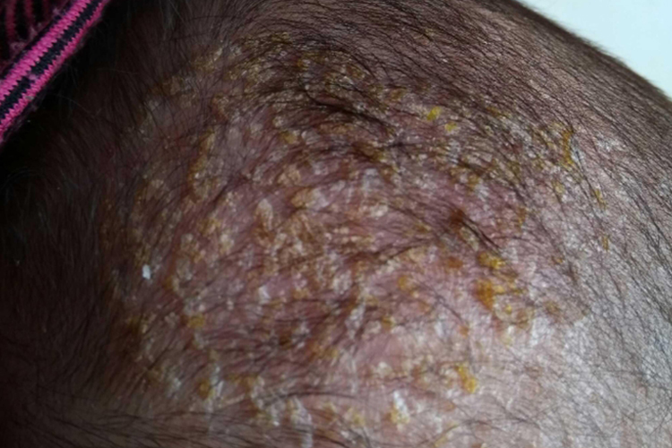 黄癣头顶大块头皮屑结痂图