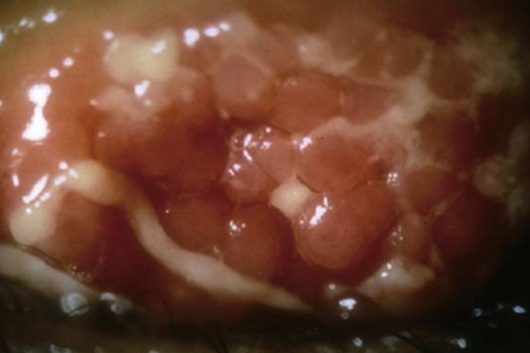 巨乳头性结膜炎肉球图 巨乳头性结膜炎肉球图