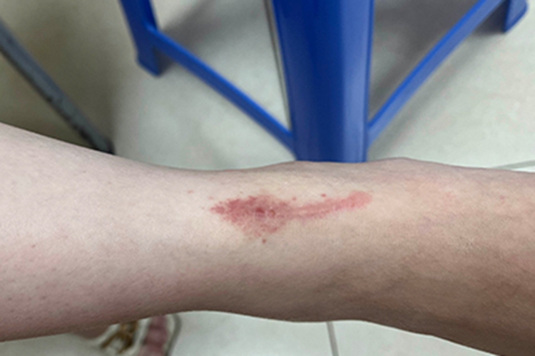 急性接触性皮炎小腿瘢痕图