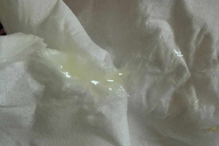 月经前正常分泌物图