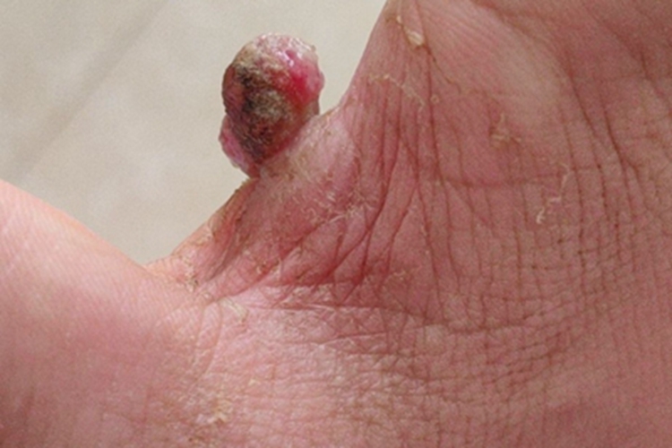 化脓性肉芽肿结痂图 化脓性肉芽肿结痂图