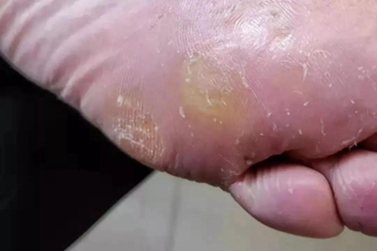 掌跖角化病脚底脱皮图