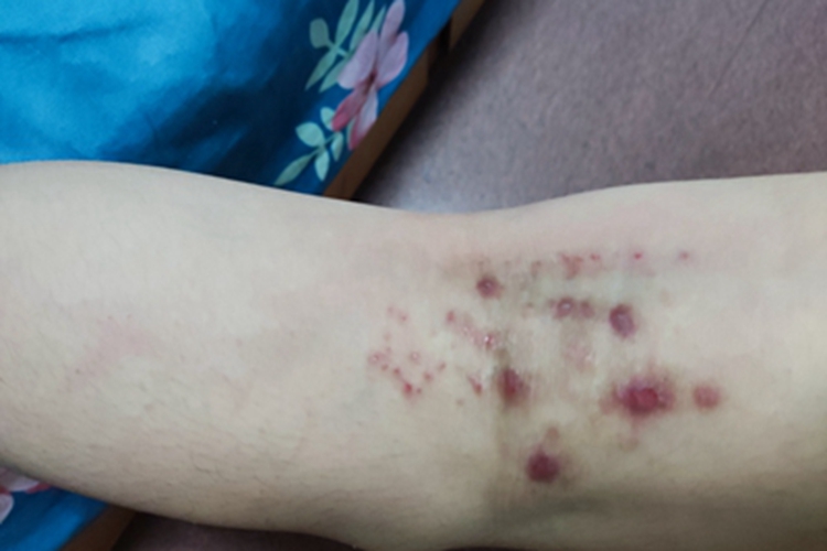 结节性痒疹腘窝症状图