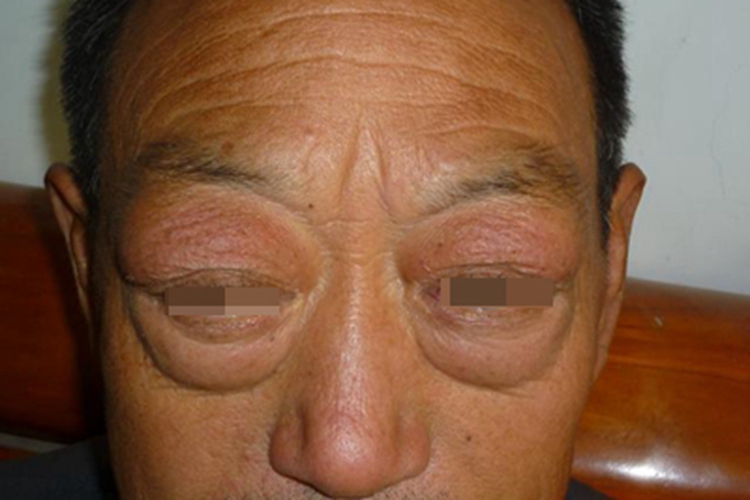甲状腺相关眼病水肿图