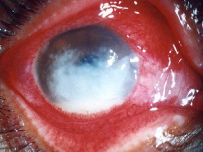 真菌性角膜炎黑眼球长白斑白眼球充血图.jpg