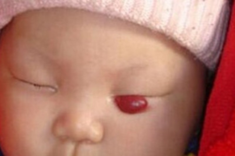 小儿血管瘤眼睑症状图 小儿血管瘤眼睑症状图