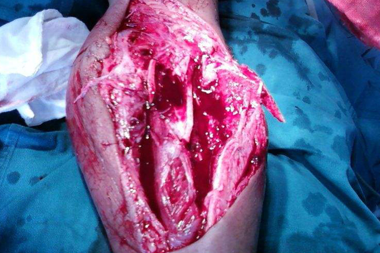 小腿第三度开放性骨折图