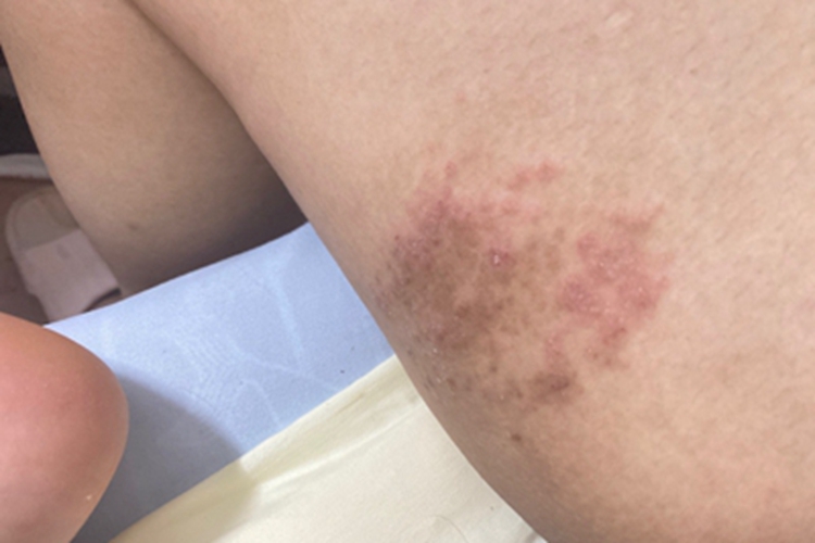 慢性湿疹大腿斑图